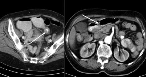 Abdominal CT scan demonstrating small bowel wall thickening and dilated... | Download Scientific ...