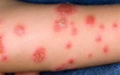 Humira now licensed for psoriasis treatment in children | MIMS online