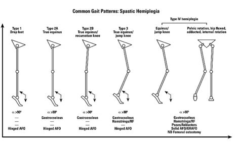 Classification of Gait Patterns in Cerebral Palsy - Physiopedia