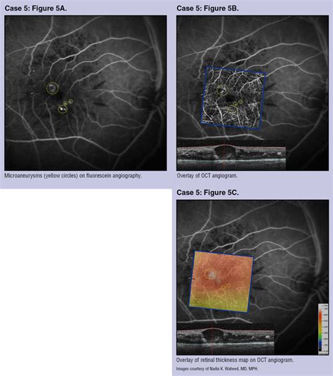 OCT Angiography: The Next ‘Big Thing’ in Retinal Imaging - OCT ...