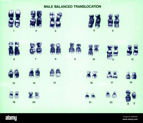 Male balanced translocation karyotype hi-res stock photography and ...