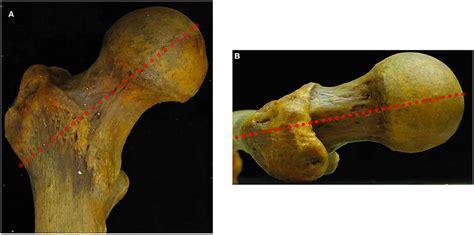 Frontiers | The Prevalence of Cam Morphology: A Cross-Sectional Evaluation of 3,558 Cadaveric Femora