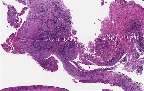 Residual Cyst Histology