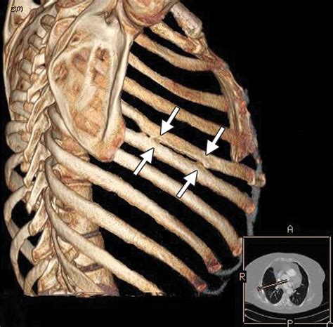 Chronic post-thoracotomy pain syndrome | CMAJ