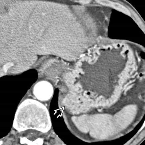 Zollinger-Ellison Syndrome | Radiology Key