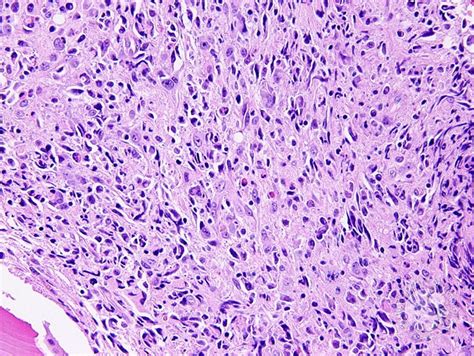 Anaplastic Large Cell Lymphoma Involving the Bone Marrow - 6.