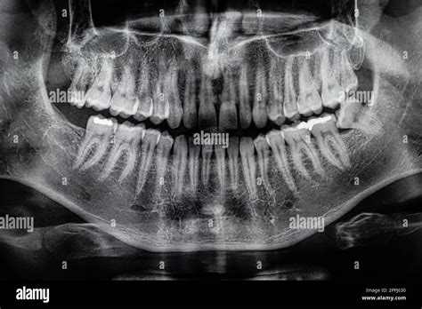 Orthopantomography, OPG X-ray DR digital wisdom teeth. panoramic film x ray dental Stock Photo ...