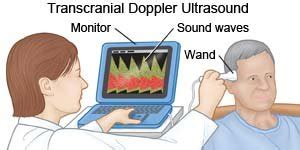 Transcranial Doppler Ultrasound (Precare)