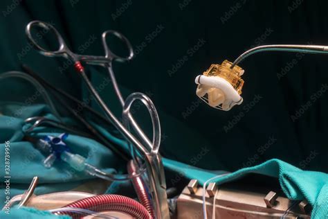 Heart valve prosthesis. Image of aortic valve implant during open heart ...