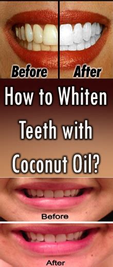 How to Whiten Teeth with Coconut Oil? - barbarasharetips.blogspot.com