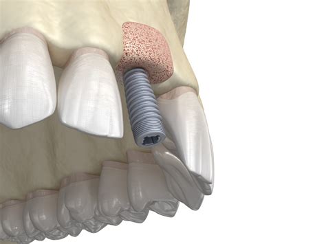 Understanding The Osseointegration Process : Garran Dental