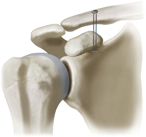 Acromioclavicular Ligament Tear