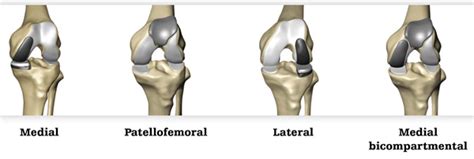 Robotic Partial Knee Replacement | Total Hip Replacement | Total Knee ...