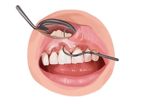 What is scaling and root planing? | Authority Dental