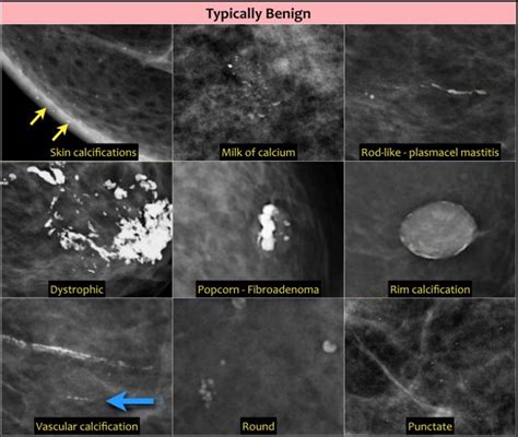 The Radiology Assistant : Bi-RADS for Mammography and Ultrasound 2013