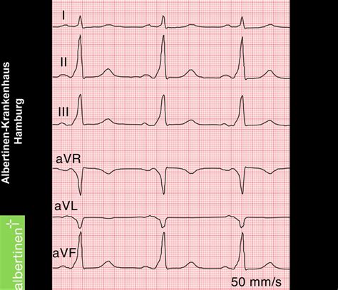 WPW Syndrome (ECG) - DocCheck