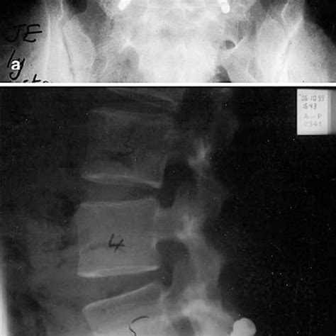 a Anteroposterior radiograph of the lumbosacral junction, 1 year after... | Download Scientific ...