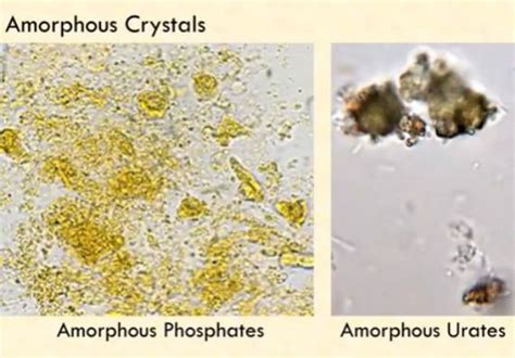 amorphous crystals | Medical Laboratories