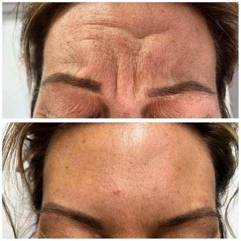 botox injection forehead wrinkles before after (2) » Facial Injections ...