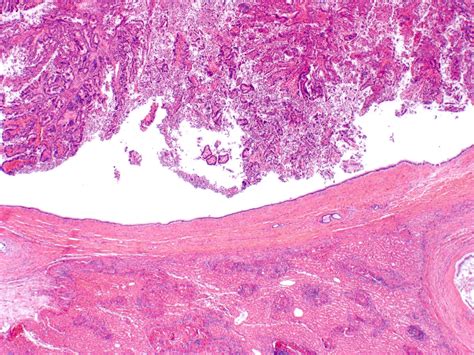 Pathology Outlines - Intraductal papillary neoplasm of the bile ducts