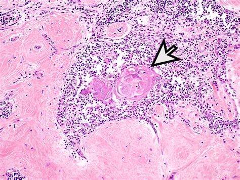 Pathology Outlines - Thymoma