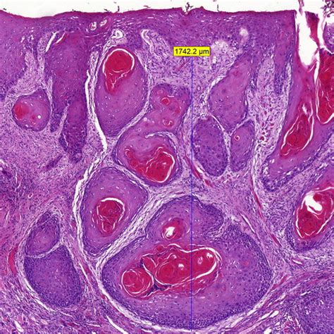 Squamous Cell Carcinoma Drawing