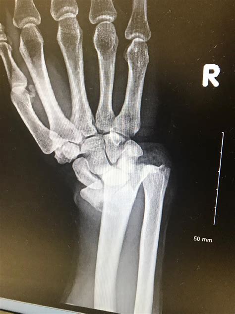 Distal Radial Fractures Treatment - Miami Hand Center