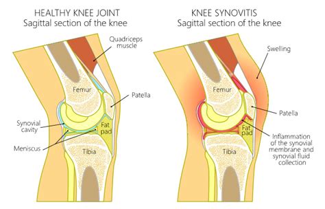 What Causes Lateral Knee Pain?