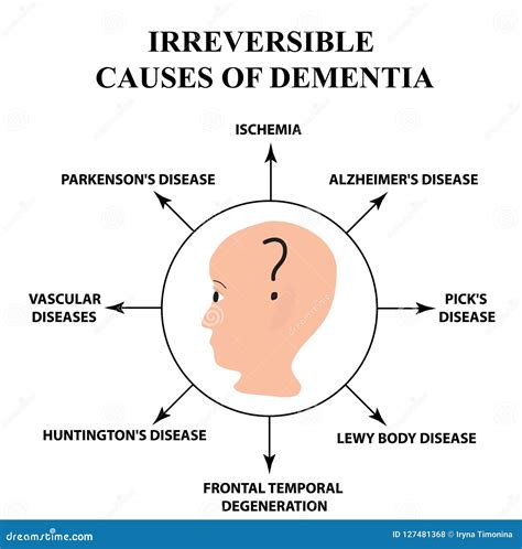 Irreversible Causes of Senile Dementia. Alzheimer`s Disease. Infographics Stock Vector ...