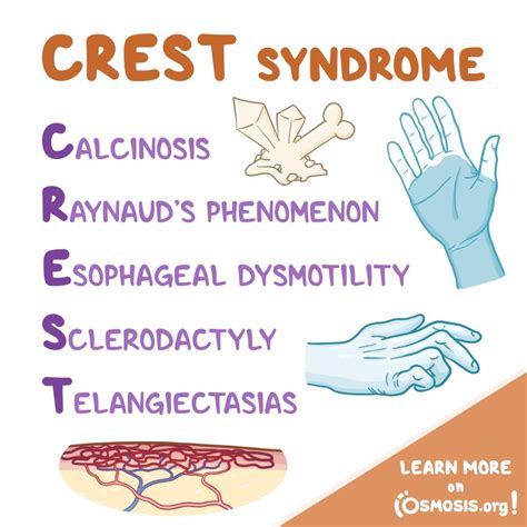 Calcinosis Scleroderma