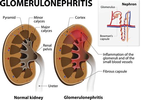 Causes of Kidney Disease