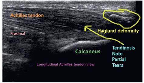 Ultrasound-Guided Injection Technique for Achilles Tendonitis | Anesthesia Key