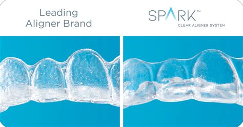 Spark™ Clear Aligners - Maryland Advanced Orthodontics | Gaithersburg MD