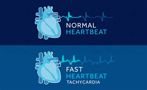 Tachycardia | Taking Care of Your Heart