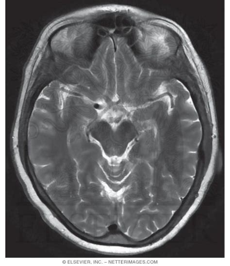 T2 Axial MRI Though the Optic Chiasm