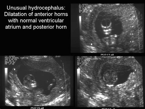 Ultrasound Criteria for the Diagnosis of Hydrocephalus