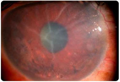 What Is Corneal Edema? Will It Go Away On Its Own? - cataractsurgerynews.com