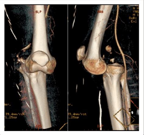 Knee Joint Dislocation - Carolinas Pain Center - Causing you knee pain?