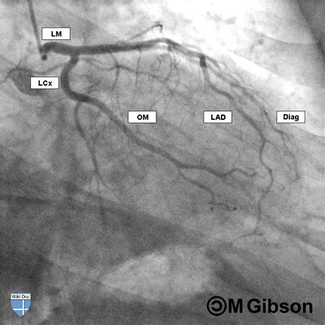 Coronary angiography left coronary artery - wikidoc