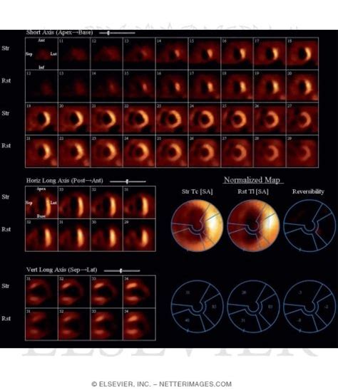 Single-Photon Emission Computed Tomography (SPECT)