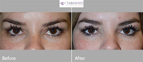 Epicanthoplasty Before and After Gallery | Taban MD