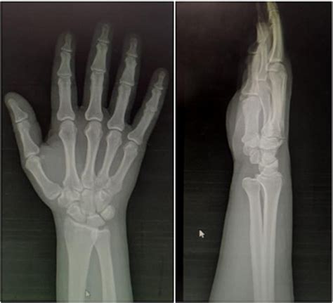 Anterior-posterior and lateral radiographs of volar distal radioulnar... | Download Scientific ...