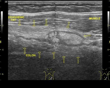 Epiploic appendagitis | Radiology Reference Article | Radiopaedia.org