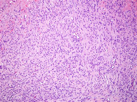 Benign Fibrous Histiocytoma | Dermatopathology