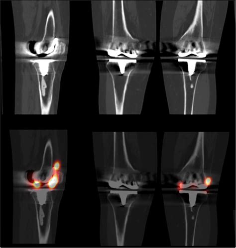 Normal left knee total arthroplasty. Sagittal (left) and coronal ...