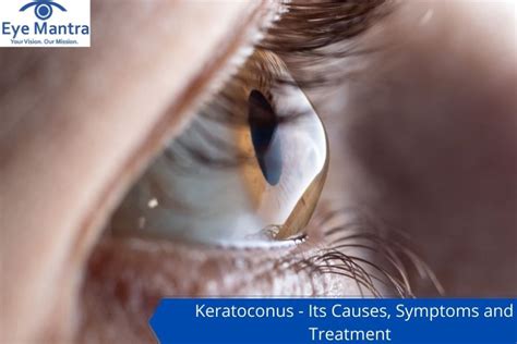 Cornea Guttata: Symptoms And Treatment | How Relate To Phaco