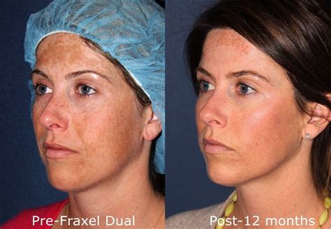 Melasma Hyperpigmentation Treatment | San Diego, CA | CLDerm