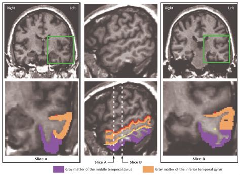 Delineation of the Middle Temporal Gyrus and Inferior Temporal Gyrus a | Download Scientific Diagram