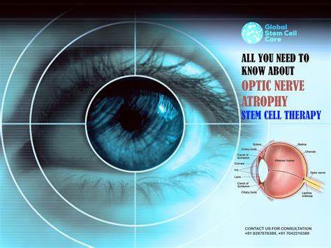 All You Need to Know About Optic Nerve Atrophy Stem Cell Therapy - Global Stem Cell Care