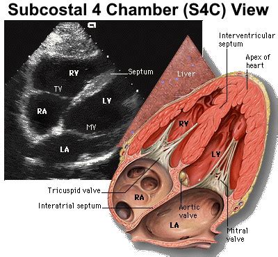 Subcostal 4 Chamber | Point of Care Ultrasound